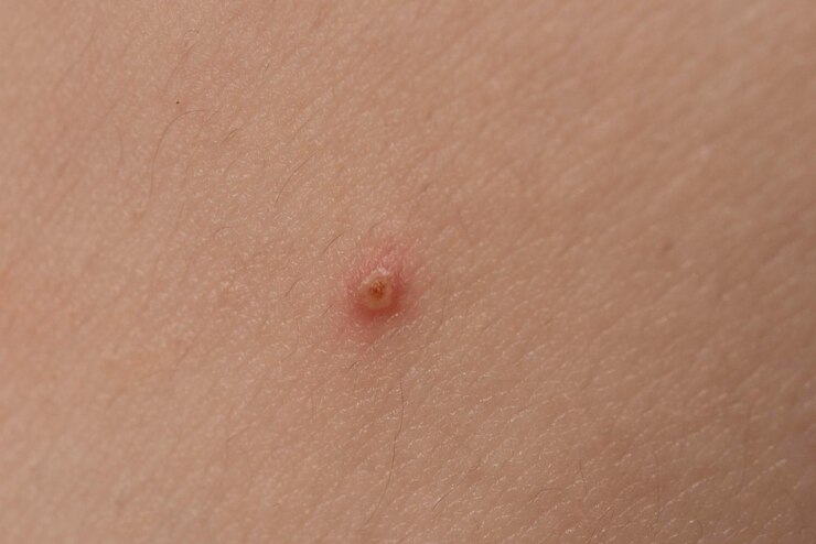 Foto tratamento de problemas de pele cuidado da pele espinhas acne de perto e cuidado da pele com espinhas dermatologia cuidado da pele