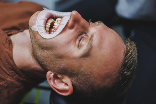 Foto tratamento dentário dos dentes um jovem na consulta do dentista o médico instala aparelho de metal nos dentes closeup de dentes com aparelho