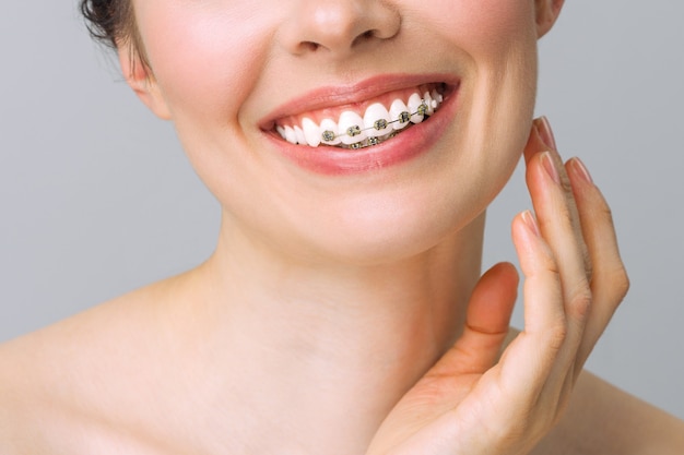 Tratamento ortodôntico. Conceito de atendimento odontológico. Sorriso saudável close-up. Closeup suportes de cerâmica e metal nos dentes. Lindo sorriso feminino com aparelho.