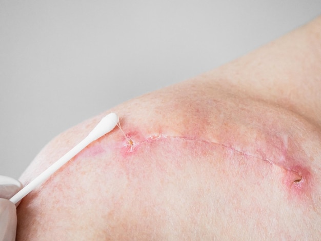 Tratamiento de cicatrices en la clavícula en el cuerpo masculino después de la fractura de cerca