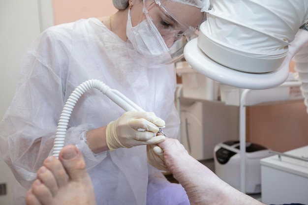 Tratamiento de hongos en las uñas de los pies en el hospital.