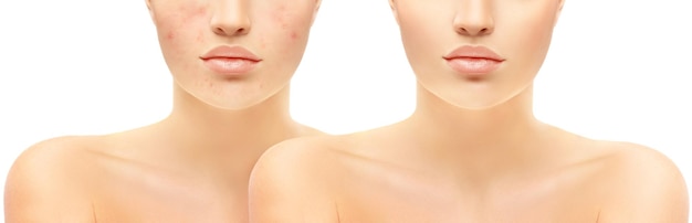 El tratamiento de las marcas de acné Las cicatrices de acné Después de la extirpación de la cicatriz de acné