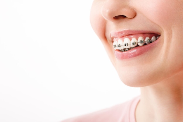 Tratamiento de ortodoncia Concepto de cuidado dental Hermosa mujer Sonrisa saludable cerrar Primer plano Soportes de cerámica y metal en los dientes Hermosa sonrisa femenina con frenos