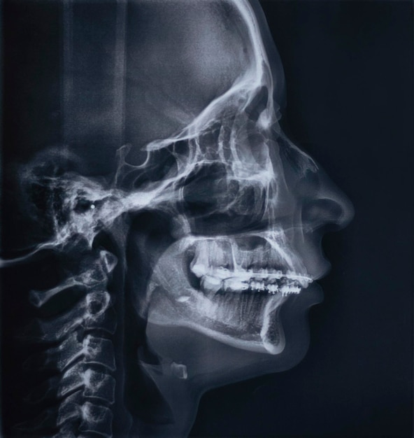 TRG de imagem de raio-x teleroentgenográfica do perfil facial