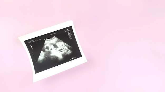 Foto triagem de ultrassom pré-natal do feto em fundo rosa conceito de gravidez copie o espaço
