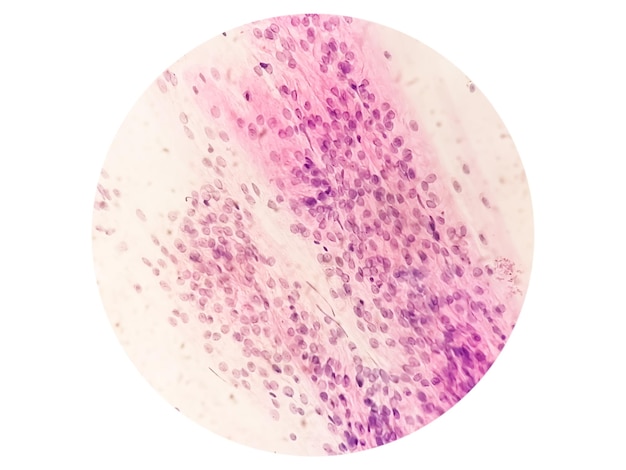 Trichomonas vaginalis en Papanicolaou con pocas células inflamatorias agudas. Tricomoniasis. ETS