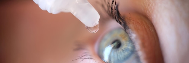 Tropfen aus der Durchstechflasche, die in das Behandlungskonzept der Konjunktivitis im Auge der Frau tropft