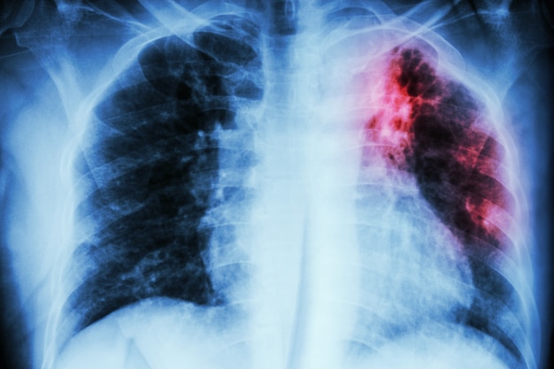 Foto tuberculosis pulmonar