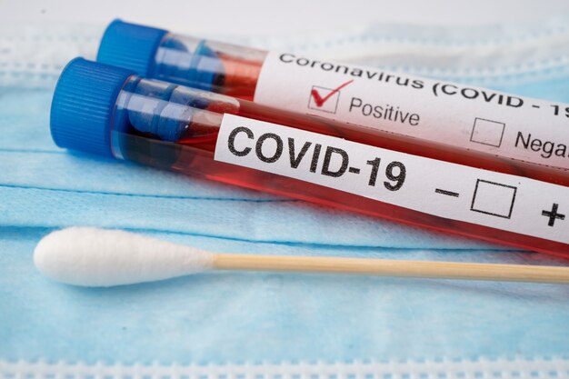 Tubo de análisis de sangre de muestra de virus COVID-19 o coronavirus en el laboratorio del hospital.