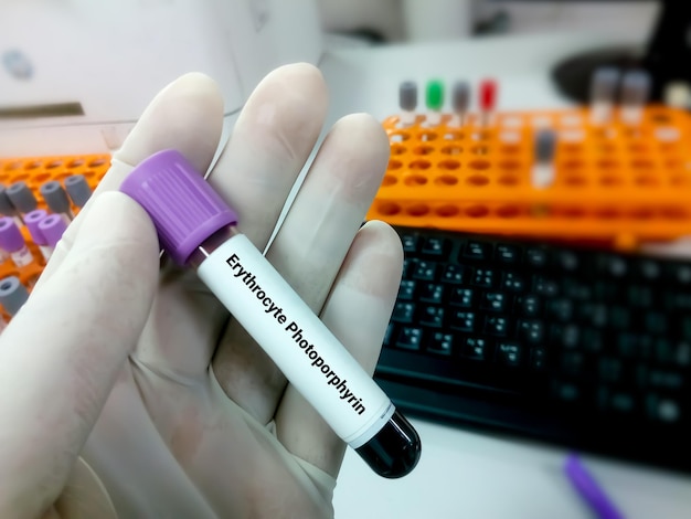 Foto tubo de amostra de sangue para teste de protoporfirina de eritrócitos para o diagnóstico de anemia