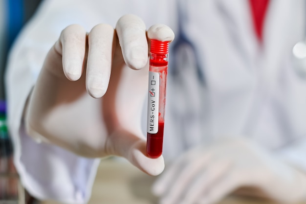 Tubo de análise de sangue na mão do médico, teste de Mers-CoV Coronavirus Rótulo positivo no tubo de análise de sangue do hospital