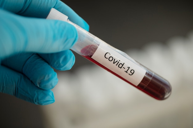 Tubo de ensaio com amostra de sangue para o teste COVID-19, coronavírus 2019