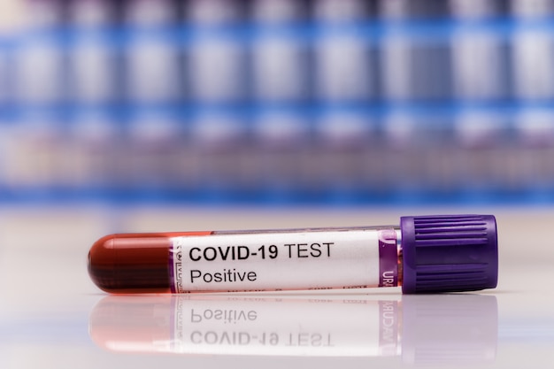 Tubo de ensaio COVID-19 positivo e amostra laboratorial de exames de sangue para diagnóstico de nova infecção pelo vírus Corona, nova doença do vírus corona do espaço hospitalar. Conceito infeccioso pandêmico