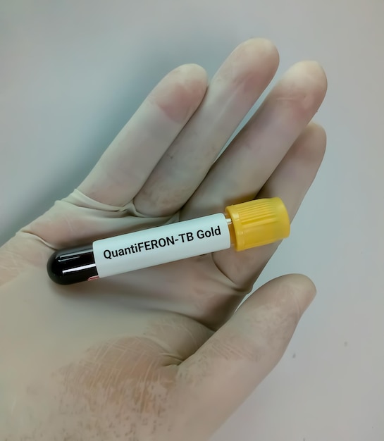 Tubo de ensayo con muestra de sangre para la prueba QuantiFERON TB Gold para el diagnóstico de tuberculosis