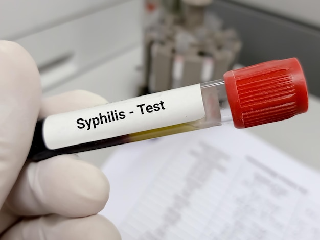 Foto tubo de ensayo con muestra de sangre para la prueba de sífilis, enfermedad de transmisión sexual