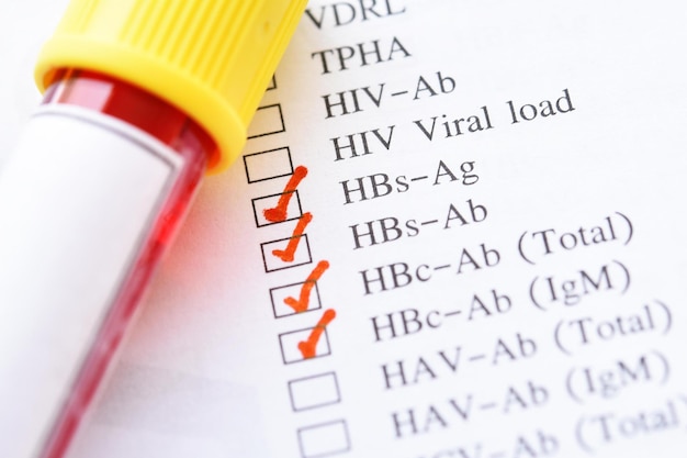 Tubo de muestra de sangre con formulario de solicitud de laboratorio para la prueba del virus de la hepatitis B
