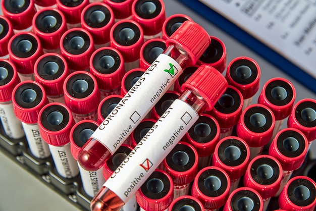 Foto tubos de análisis de sangre para covid-19 en tubos de vacío con muestras de sangre.