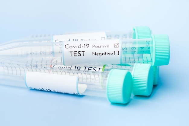 Tubos de ensayo para muestras de coronavirus Covis-19 con resultado positivo.