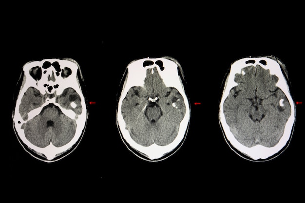 Foto tumor cerebral cístico