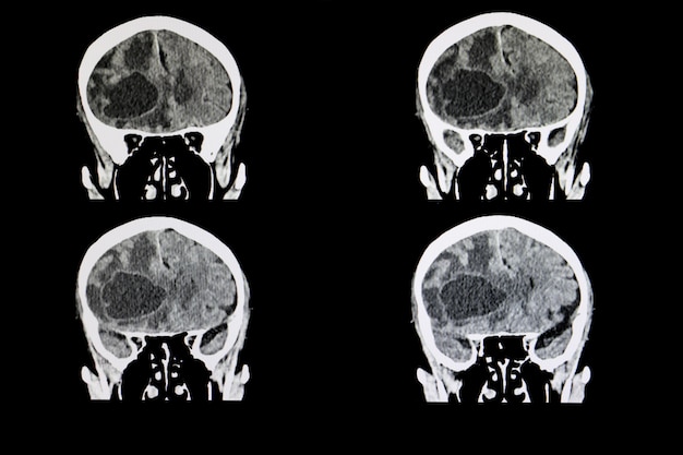 Tumor cerebral metastático