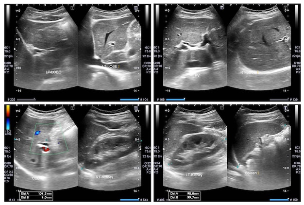 Ultrasonido del abdomen superior muestra hígado, páncreas y riñón aparecen los riñones.