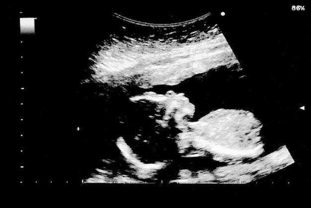 Ultrasonido del bebé en el vientre materno.