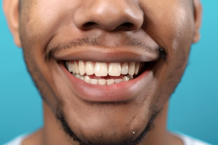 Foto um close de um sorriso masculino com uma lacuna entre seus dois dentes dianteiros
