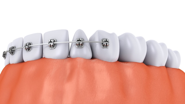 Um dente com aparelho e implantes dentários