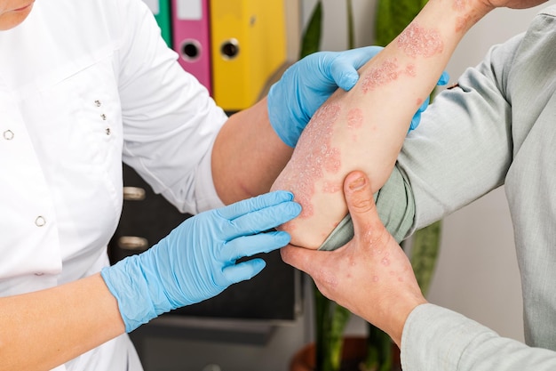 Um dermatologista usando luvas examina a pele de um paciente doente. Exame e diagnóstico de doenças de pele-alergias, psoríase, eczema, dermatite.