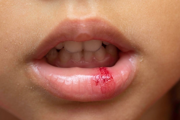 Um extremo close-up e vista frontal de um lábio sangrento de criança ferida por acidente ao ar livre Jovem no hospital esperando assistência pediátrica