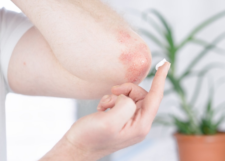 Foto um homem aplica um creme no cotovelo afetado pela psoríase