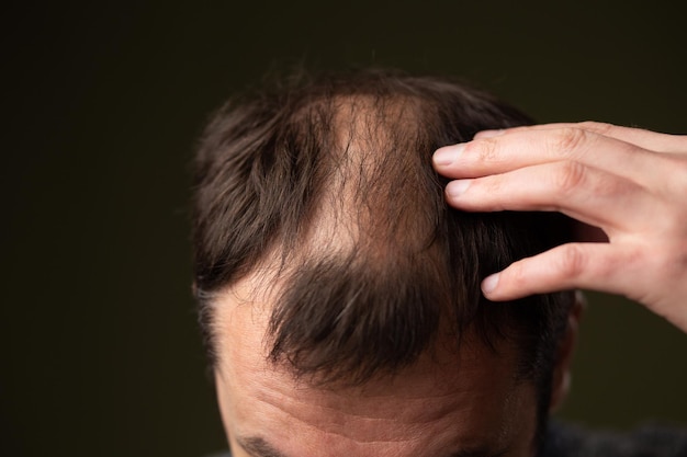 Um homem com calvície em um close-up da cabeça de fundo escuro.