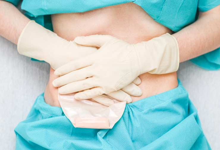 Foto um paciente de pijama com o abdômen aberto pressiona a bolsa de colostomia com as mãos em luvas estéreis