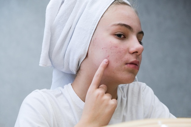 Menina De Scowling Que Aponta Para Sua Acne Com Uma Toalha Em Sua Cabeça.  Conceito Do Cuidado Da Pele Da Mulher, Fotos Da Menina Feia Da Pele Do  Problema No Fundo Branco