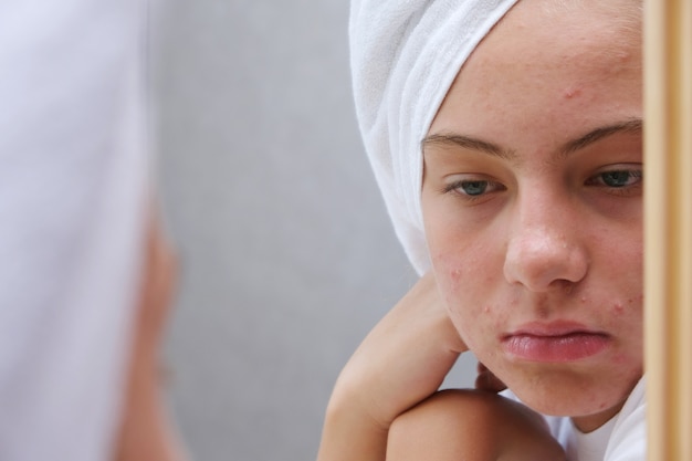 Uma adolescente triste está olhando para as espinhas em seu rosto no espelho. Pele problemática em adolescentes. Acne.