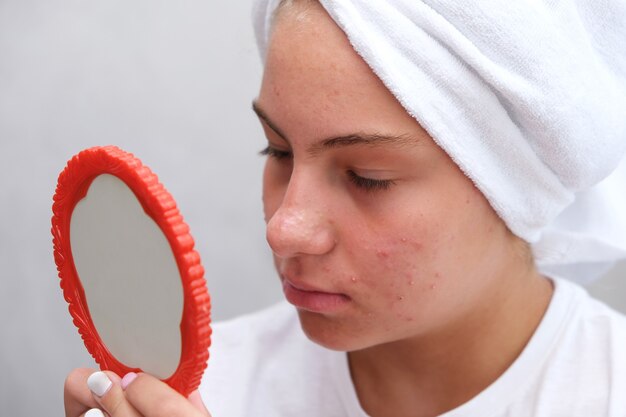 Foto uma adolescente triste está olhando para as espinhas em seu rosto no espelho. pele problemática em adolescentes. acne.