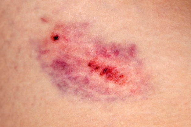 Uma contusão em close-up na pele da perna de uma mulher ferida. Violência doméstica.