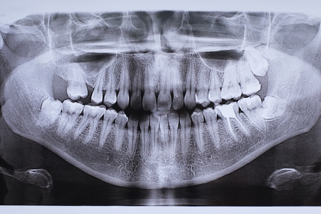 uma foto de uma mandíbula com um dente implantado