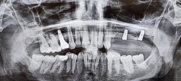 Uma imagem de ortopantomografia com implantes dentários