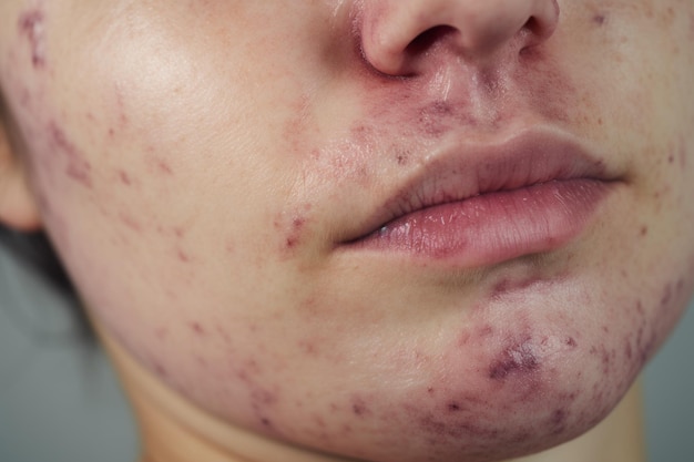 Foto uma mulher com acne no rosto