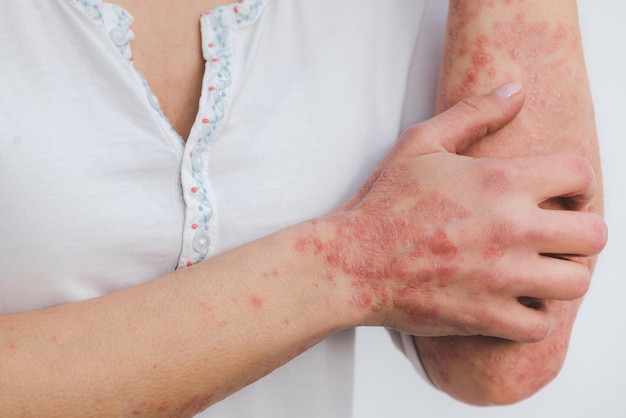 uma mulher com psoríase no braço psoríase psoríase condição da pele do braço