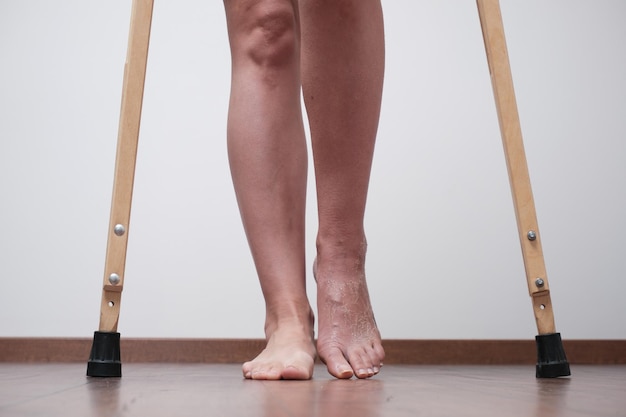 Foto uma mulher depois de uma perna quebrada para aprender a andar reabilitação após a remoção da bandagem de gesso