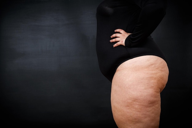 Foto uma mulher gorda com celulite fica de lado em um fundo preto foto de alta qualidade