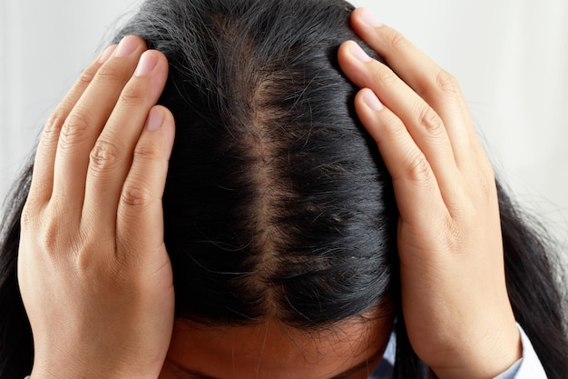Uma mulher tem problemas com cabelo e couro cabeludo, ela tem caspa devido a reações alérgicas a xampus. e condicionador de cabelo