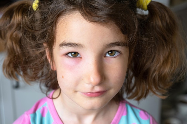 Uma pálpebra vermelha e inchada no rosto de uma criança em close é uma alergia a uma picada de inseto Reação alérgica a insetos sugadores de sangue
