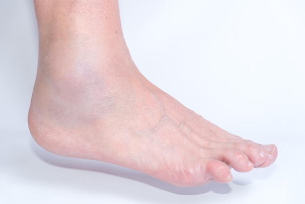 Foto uma pessoa com um pé torcido, um tornozelo deslocado, uma contusão, uma bota de caminhante