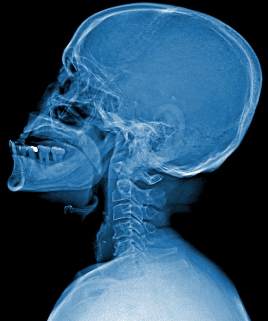 Foto uma varredura azul de uma cabeça humana com o maxilar inferior mostrando o maxilar inferior.