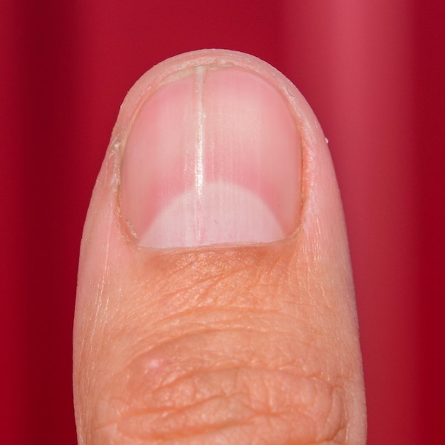 Uña bifurcada en el pulgar Dilatación de la uña patología traumática La uña se divide por la mitad
