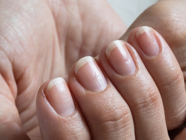 Uñas dañadas después del esmalte en gel. De cerca.