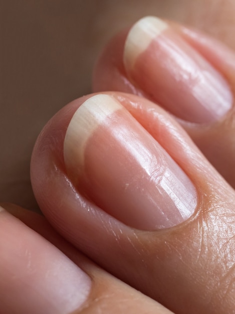 Uñas dañadas después del esmalte en gel.